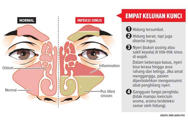 Mengatasi Sakit Kepala Akibat Sinusitis Penanganan Dan Pencegahan